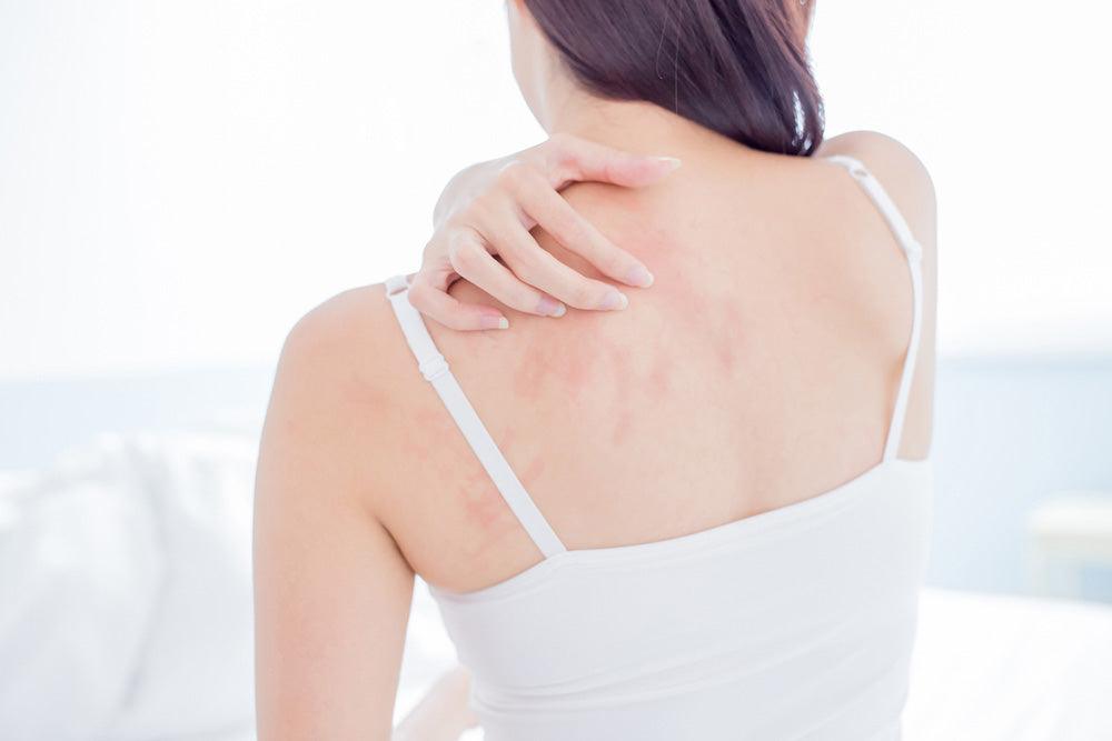 What Is Eczema? - Shea Your Way