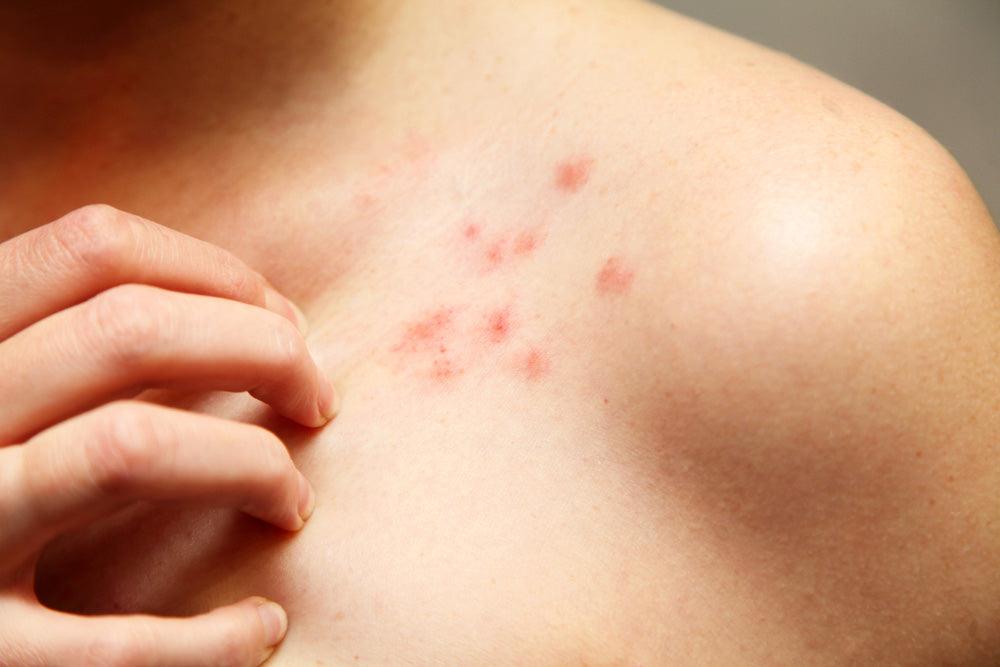 3 Ways To Prevent Eczema - Shea Your Way